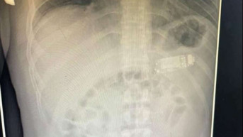 Rendgenski snimak, progutan telefon.jpg