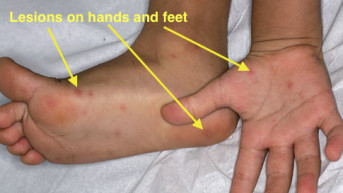 Koksaki virus, slika.jpg