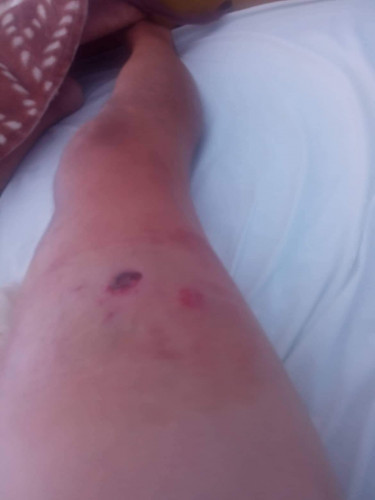 Upucani Srbin sa prostrelnom ranom na desnoj butini Upucani Srbin sa prostrelnom ranom na desnoj butini