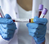 Koronavirus laboratorija uzorci krvi kovid